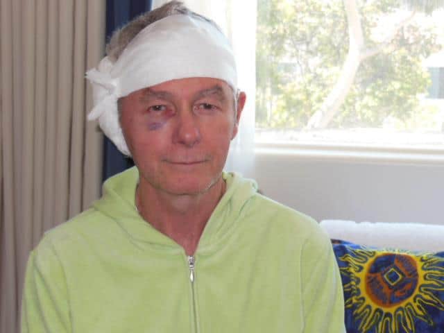 Noel, who has sudden hearing loss, after cochlear implant surgery